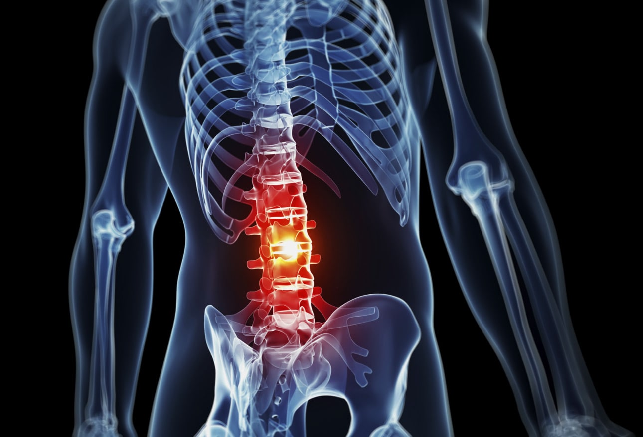 My Bone: hatékony megoldás izomszöveti fájdalom és duzzanat kezelésére